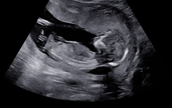 Ultrasound of a baby due June 2022